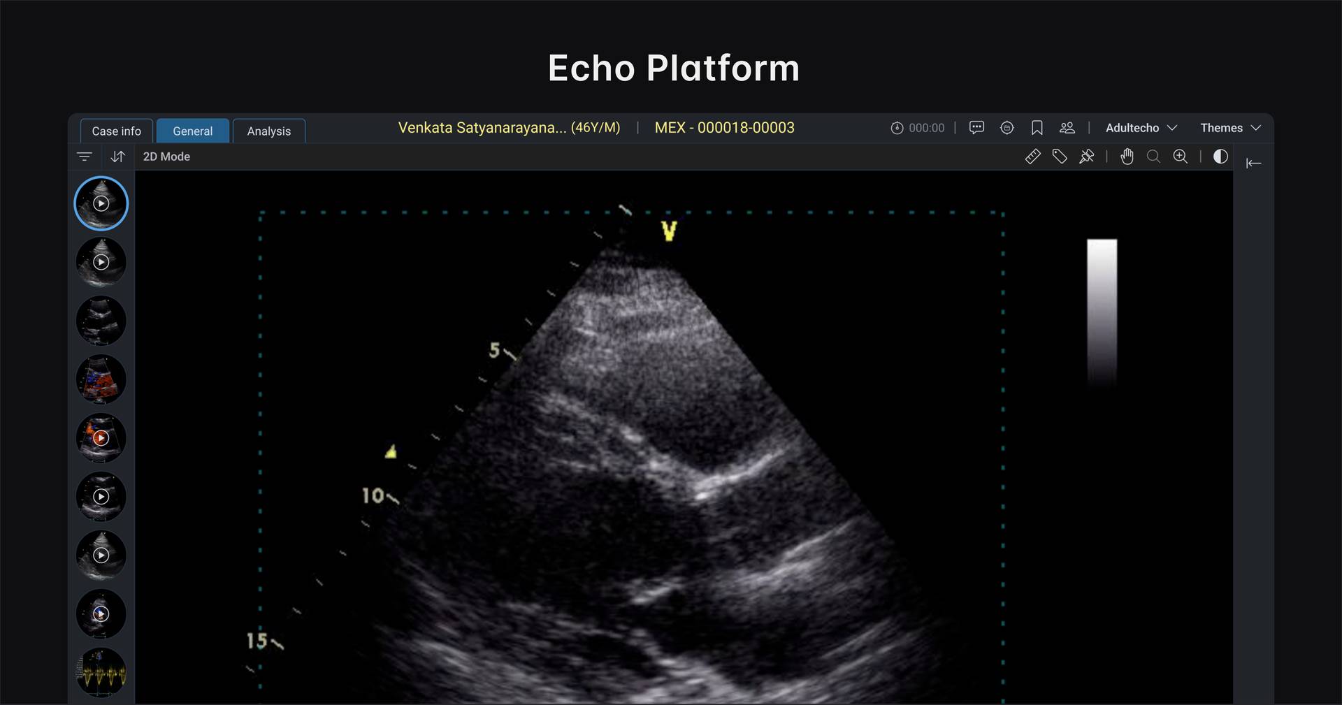 Tricog: Echocardiography Platform