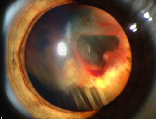 RetinaVision